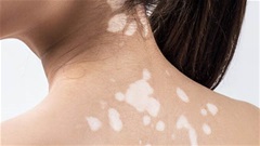 Đông y Bảo Thanh Đường: Khắc tinh của bệnh bạch biến